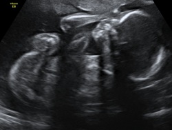Echographie